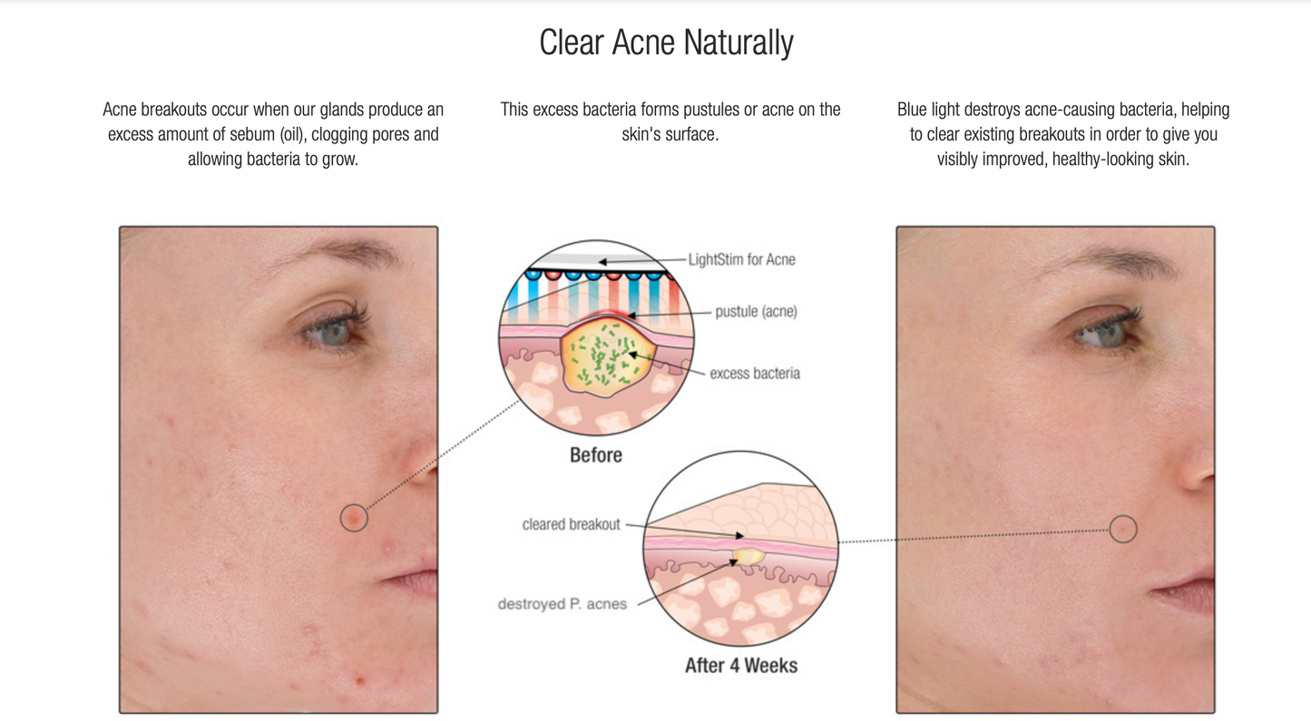 Lightstim for acne