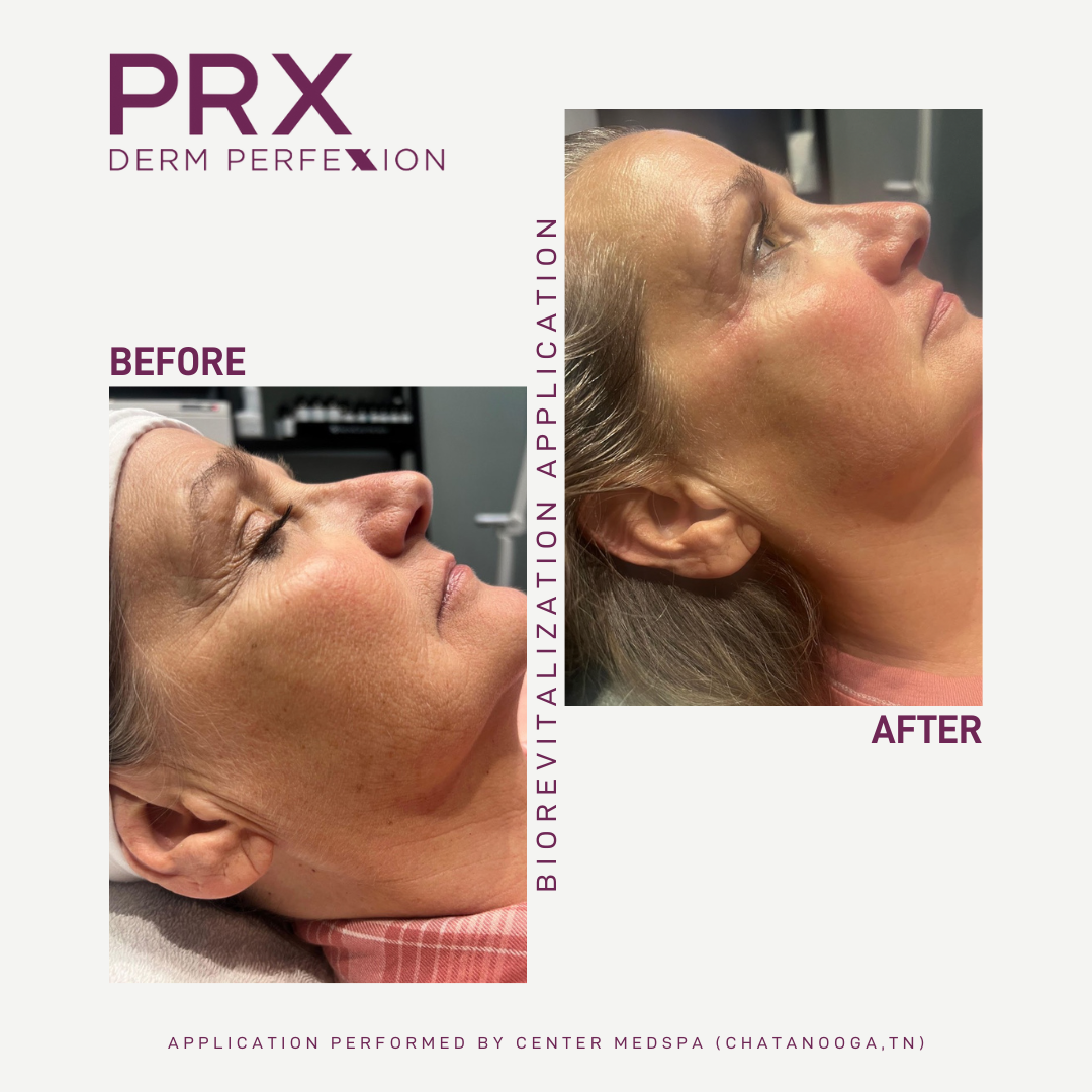 PRX Derm Perfexion (Package of 4)