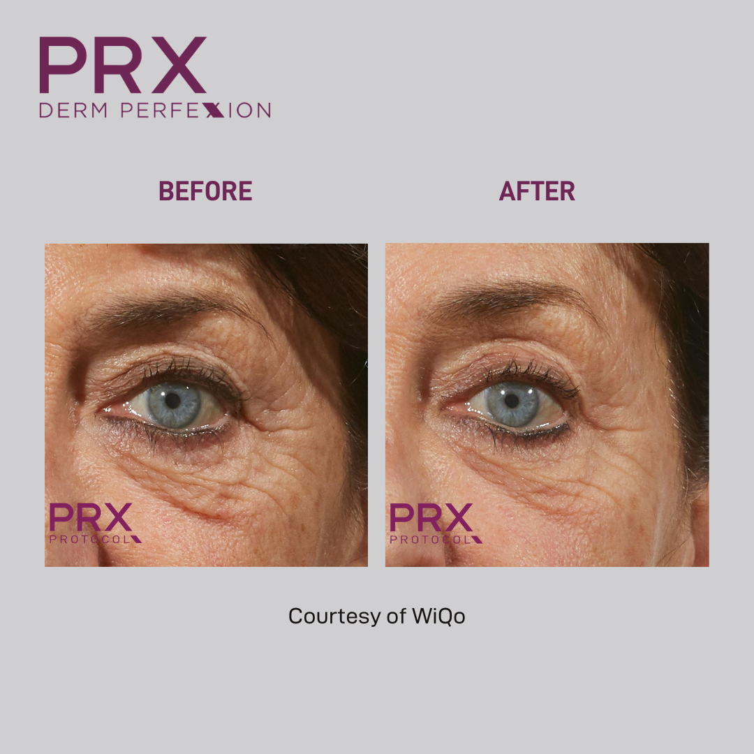 PRX Derm Perfexion (Package of 4)