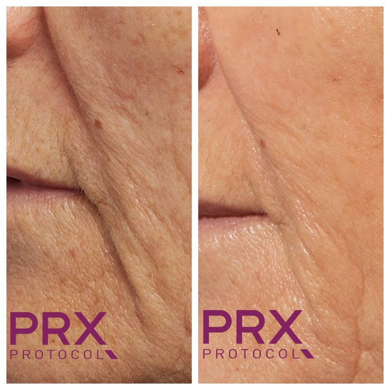 PRX Derm Perfexion (Package of 4)