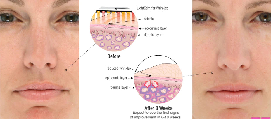 Lightstim for wrinkles